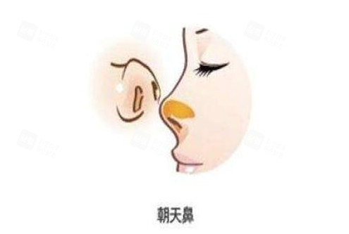 朝天鼻整形手术.jpg