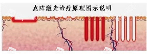 点阵激光祛疤.jpg