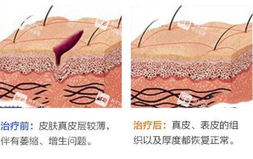 激光祛疤前后对比示意图.jpg