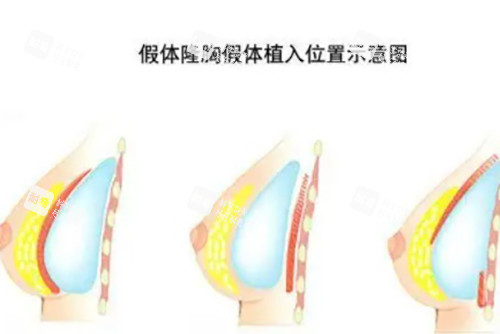 假体隆胸示意图.jpg