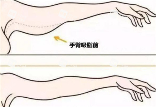 手臂吸脂.jpg 手臂吸脂.jpg