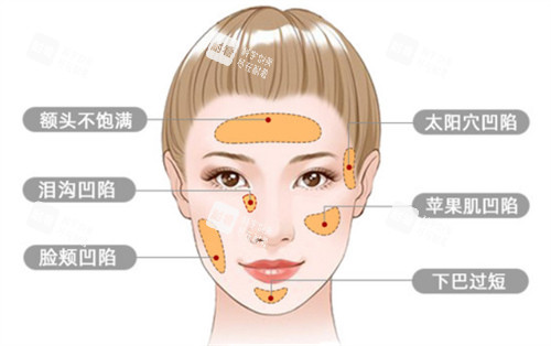 面部脂肪填充适应症.jpg