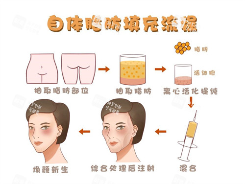 面部自体脂肪填充流程演示动画图.jpg 面部自体脂肪填充流程演示动画图.jpg