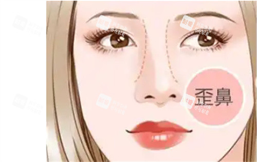 歪鼻修复.jpg