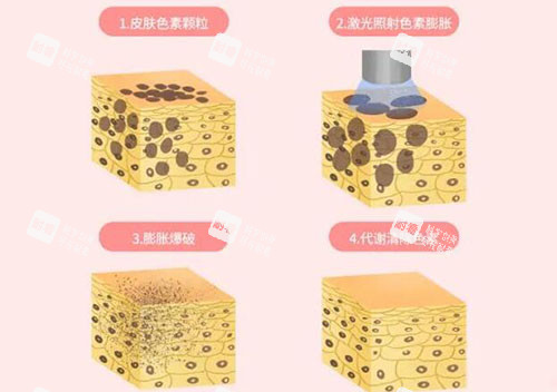 超皮秒皮肤改善原理.jpg