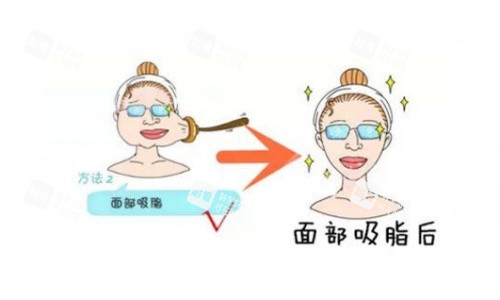 面部吸脂术后示意图.jpg