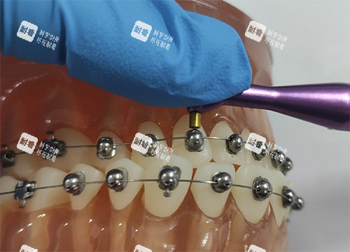 牙齿矫正OBrace球面托槽细节示意图.jpg 牙齿矫正OBrace球面托槽细节示意图.jpg