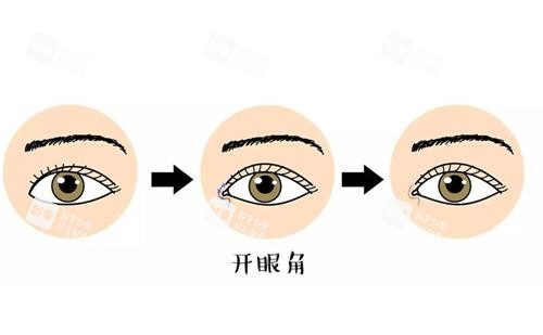 开眼角前后对比漫画图.png 开眼角前后对比漫画图.png