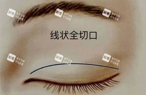 双眼皮失败怎么办.jpg