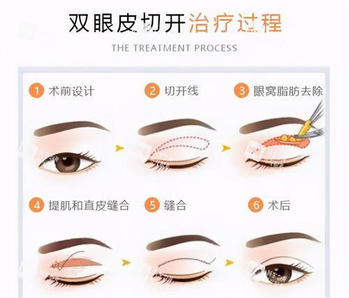 双眼皮手术方法过程图.jpg 双眼皮手术方法过程图.jpg