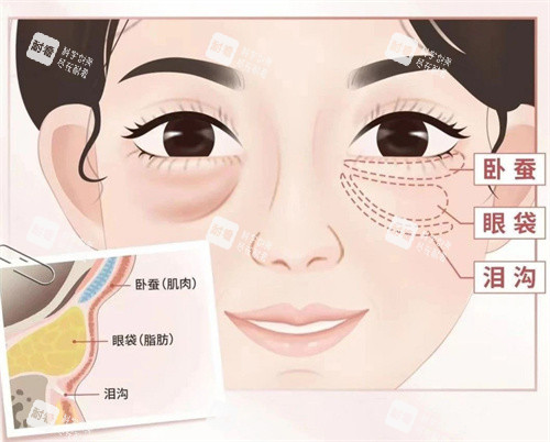 眼袋图片展示.jpg