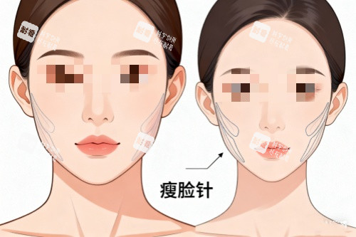 针剂注射瘦脸对比图.jpg 针剂注射瘦脸对比图.jpg
