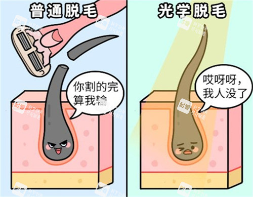 激光脱毛和普通刮毛的区别.jpg