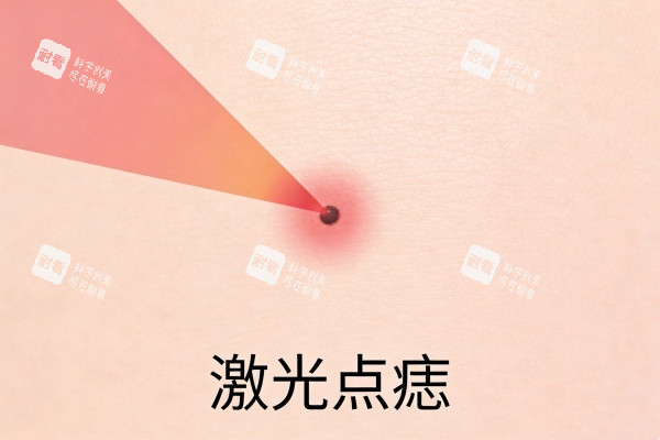 激光点痣卡通图展示.jpg