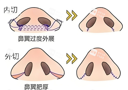 鼻翼缩小内切外切对比.jpg 鼻翼缩小内切外切对比.jpg
