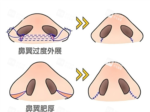 鼻翼缩小手术方式动画图.jpg 鼻翼缩小手术方式动画图.jpg