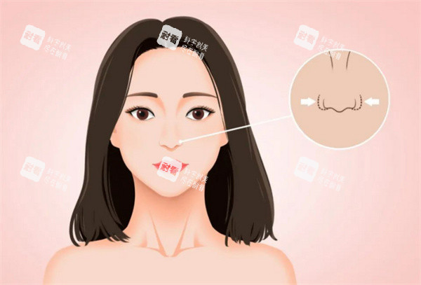 鼻翼缩小手术卡通图.jpg 鼻翼缩小手术卡通图.jpg
