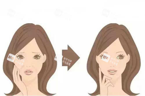 面部注射卡通对比图.jpg