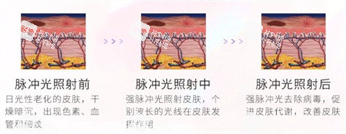 光子嫩肤对比.jpg 光子嫩肤对比.jpg