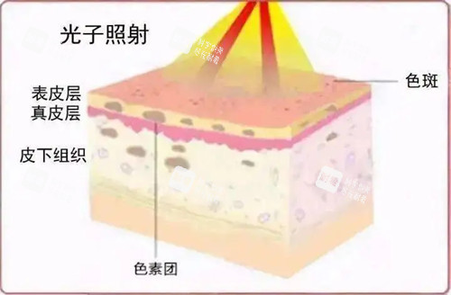 光子嫩肤原理卡通示意图.jpg