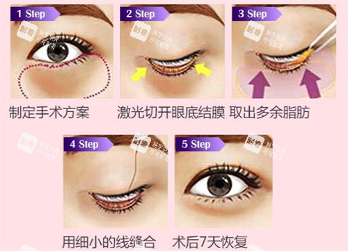 去眼袋手术过程.jpg 去眼袋手术过程.jpg