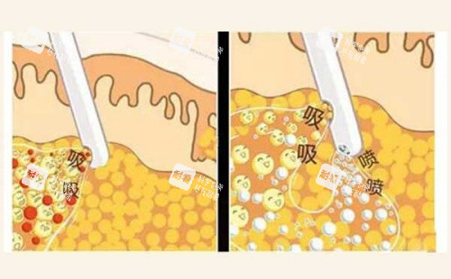 吸脂操作示意图.jpg 吸脂操作示意图.jpg