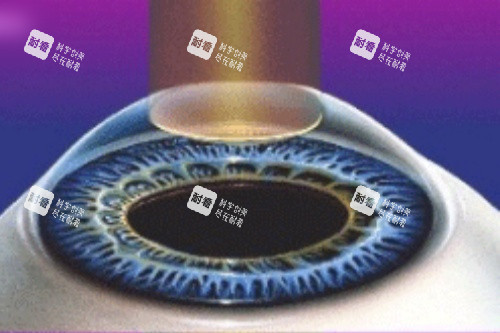 全激光手术.jpg