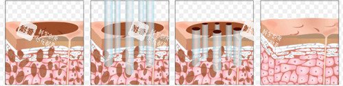 激光祛斑前后皮肤的对比.jpg