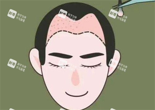 M型发际线种植.jpg