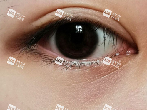 眼下细纹实拍.jpg