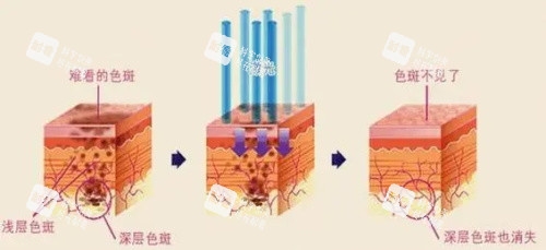 激光祛斑治疗示意图.jpg