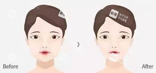 面部轮廓整形前后对比图.jpg