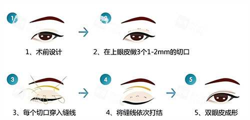双眼皮三点术过程原理.jpg