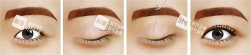 埋线双眼皮手术步骤.jpg