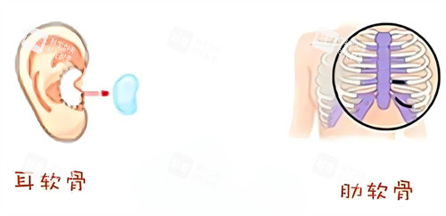 隆鼻耳软骨鼻肋骨鼻取材区别.jpg 隆鼻耳软骨鼻肋骨鼻取材区别.jpg