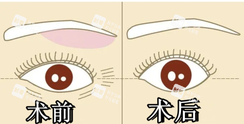 提眉术前术后对比图.png