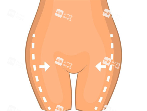大腿吸脂手术卡通图.jpg