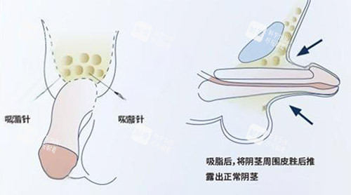 吸脂增大阴茎照片.jpg