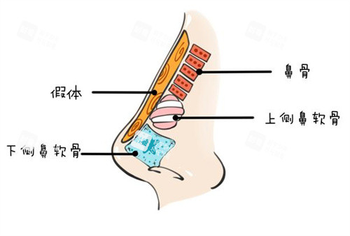 隆鼻假体图.jpg 隆鼻假体图.jpg