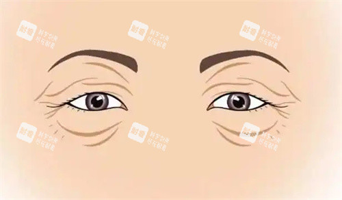 衰老的双眼皮.jpg 衰老的双眼皮.jpg