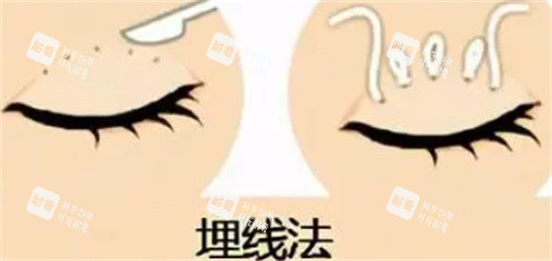 双眼皮埋线怎么做的.jpg 双眼皮埋线怎么做的.jpg