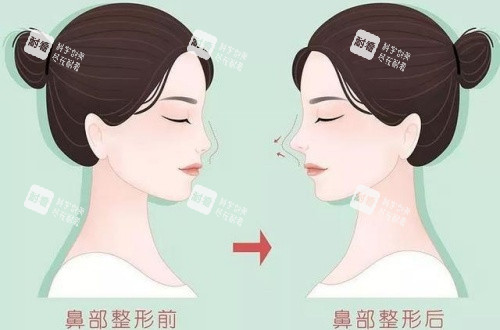 隆鼻术后漫画示意图.jpg