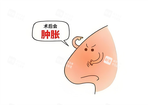 隆鼻术后肿胀动画图.jpg