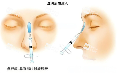 隆鼻玻尿酸注射图.jpg