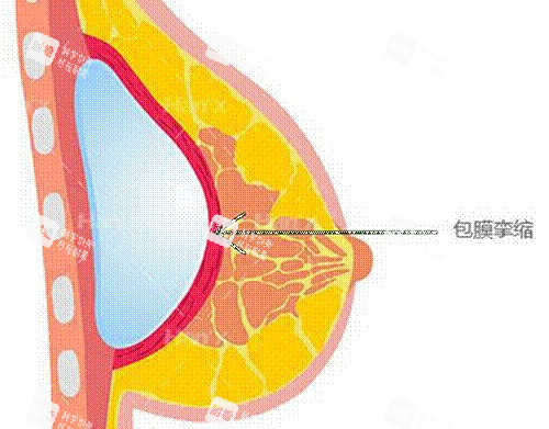 假体丰胸薄膜挛缩示意图.jpg