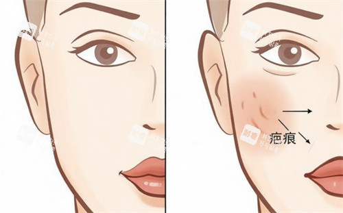 祛疤前后对比卡通图.jpg