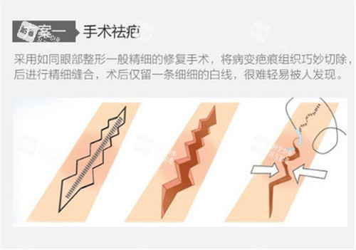 手术祛疤原理图.jpg