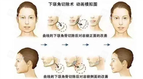 下颌角整形对比.jpg