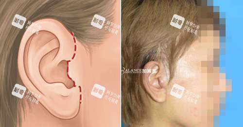 北京加减美v9手术优势不留疤痕.png 北京加减美v9手术优势不留疤痕.png