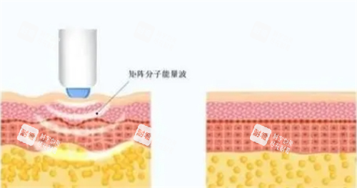 热玛吉项目皮肤剖面图.png 热玛吉项目皮肤剖面图.png